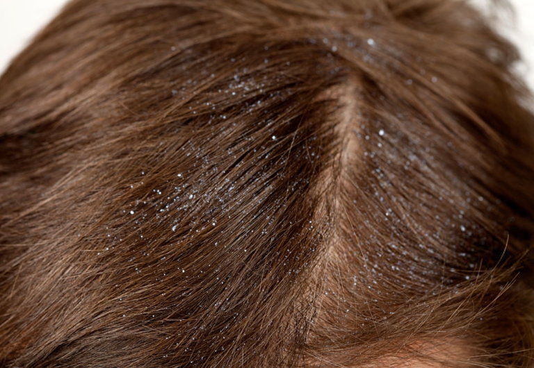 How to Get Rid of Dandruff; Fast Natural Treatments