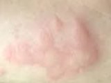 what does a cockroach bite look like