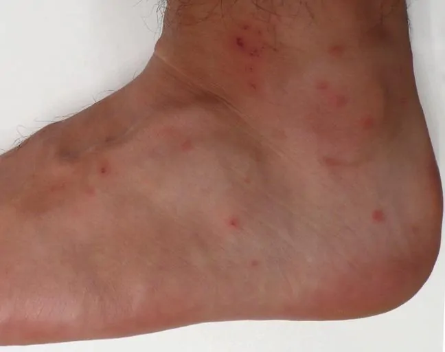 Pirate Bug Bites