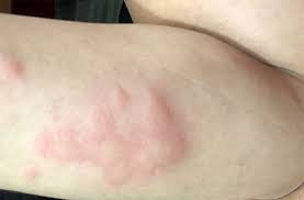 What happens if a cockroach bites you? Picture