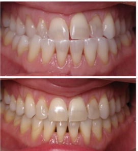 How Do You Get Treatment For Edge-To-Edge Bite