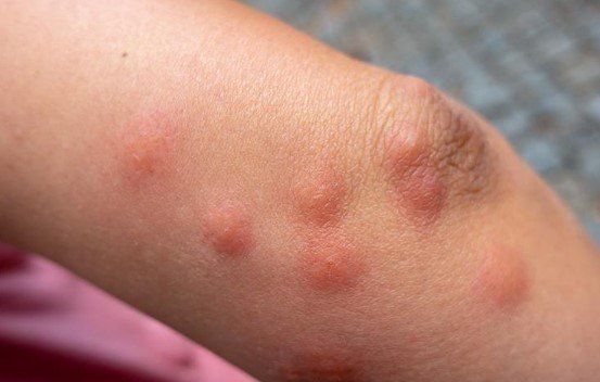 Bat Bug Bites